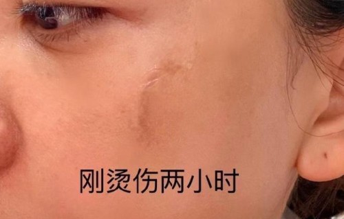 杨蓉晒烫伤疤痕恢复照直言带疤很酷 打破女演员完美颜值滤镜